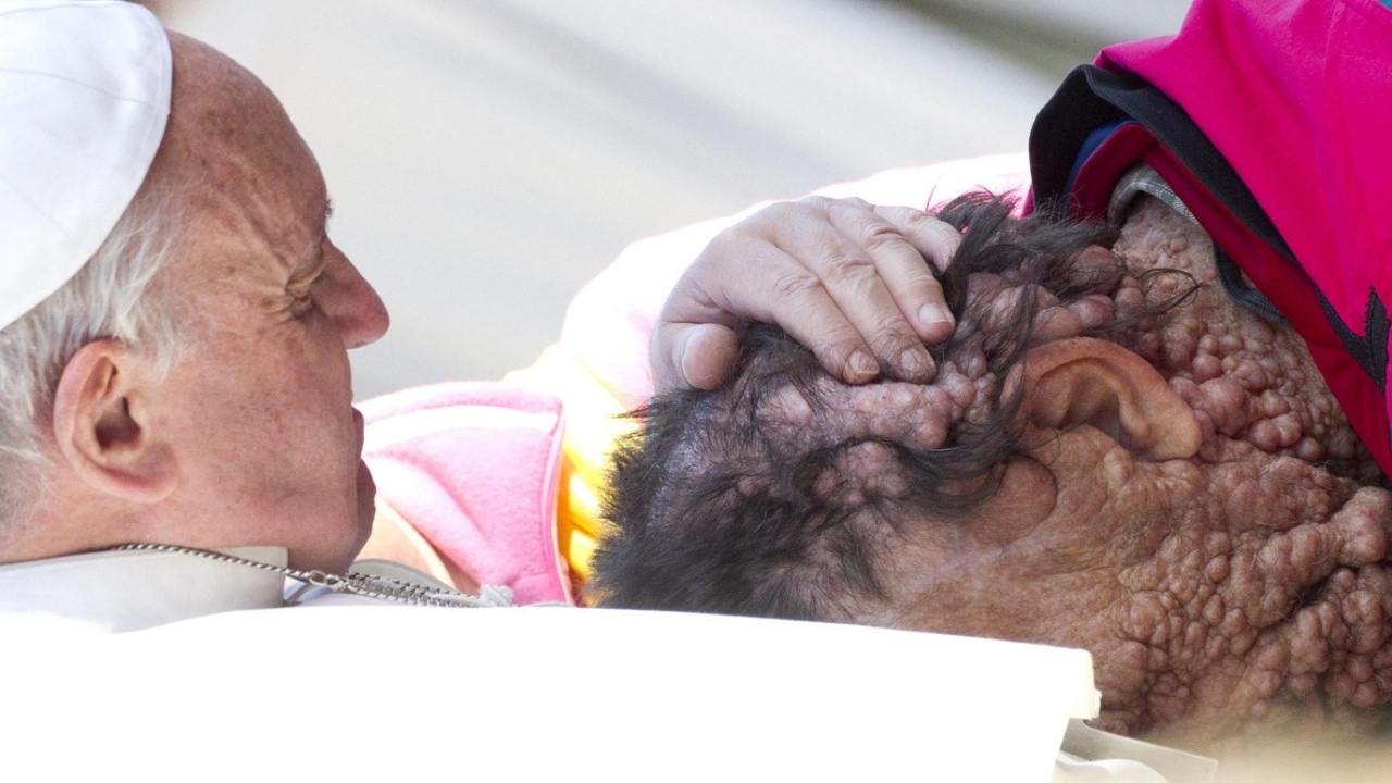 Pope Francis embraces Vinicio Riva, a man scarred by a genetic disease. This was one of many progressive acts that the new leader of the Church made. 2013