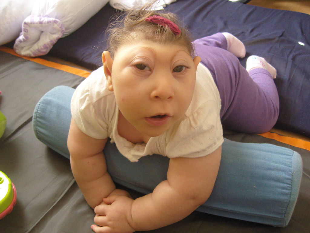 This girl was born with Anecephaly. She was born without a brain.