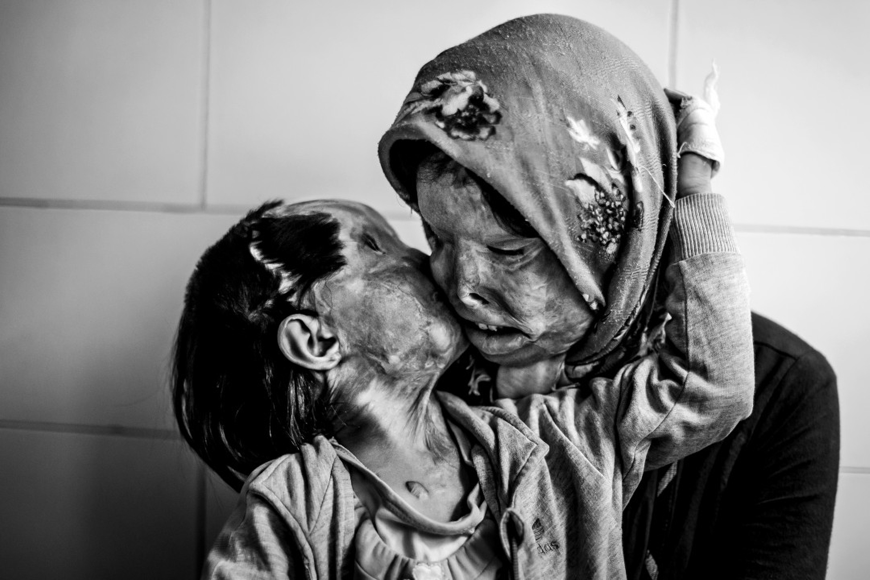 An Iranian woman and her 3 year old daughter, disfigured from an acid attack from the husband,father.