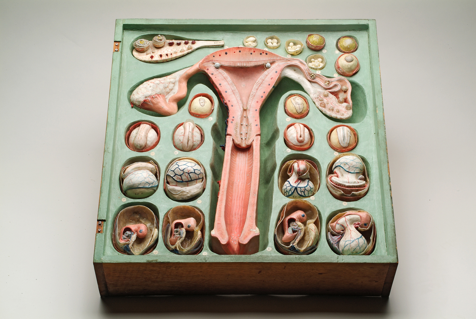 Papier Mache gynecological model created byDr Louis Auzoux c 1880