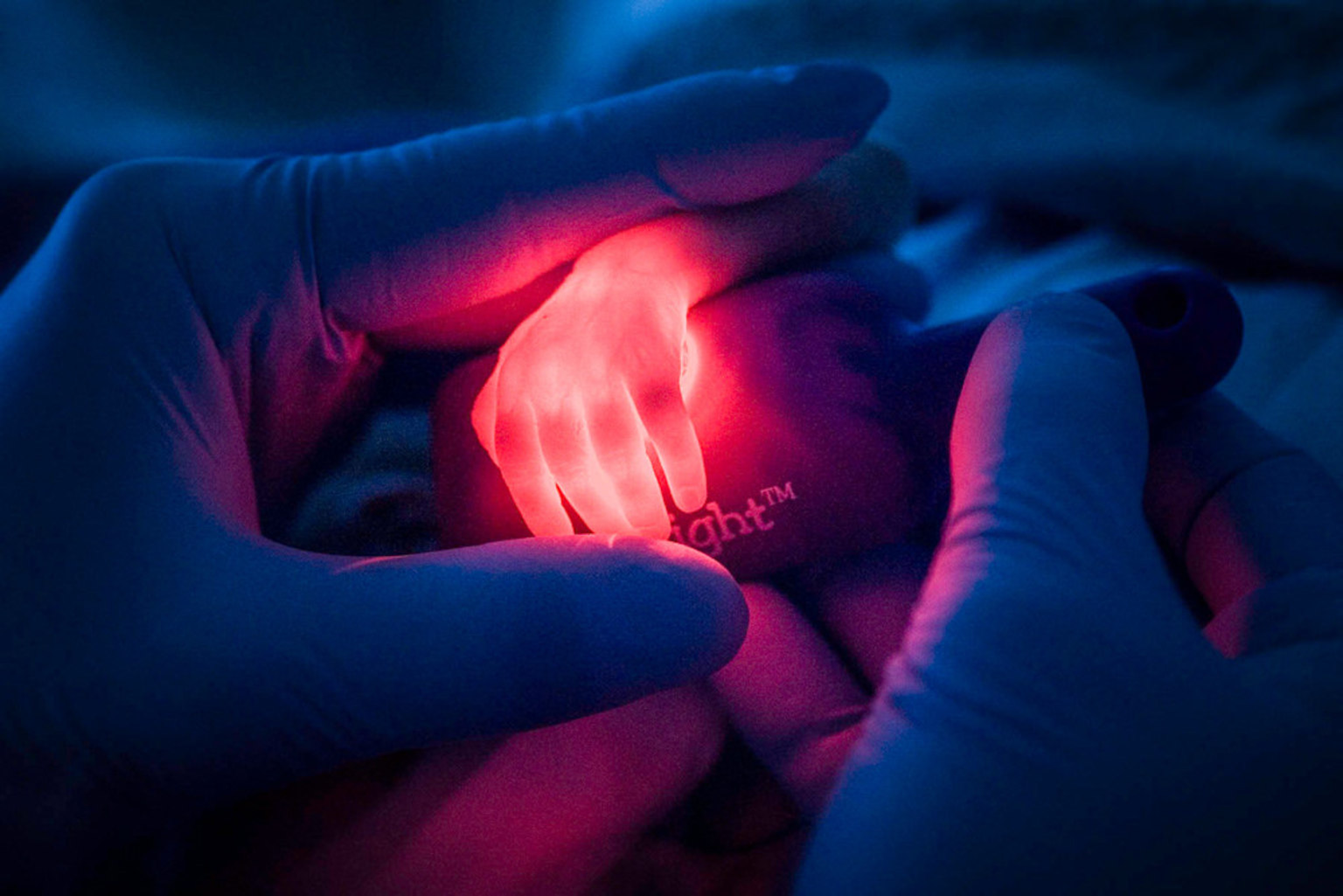 A nurse is looking for a vein on the hand of a premature baby