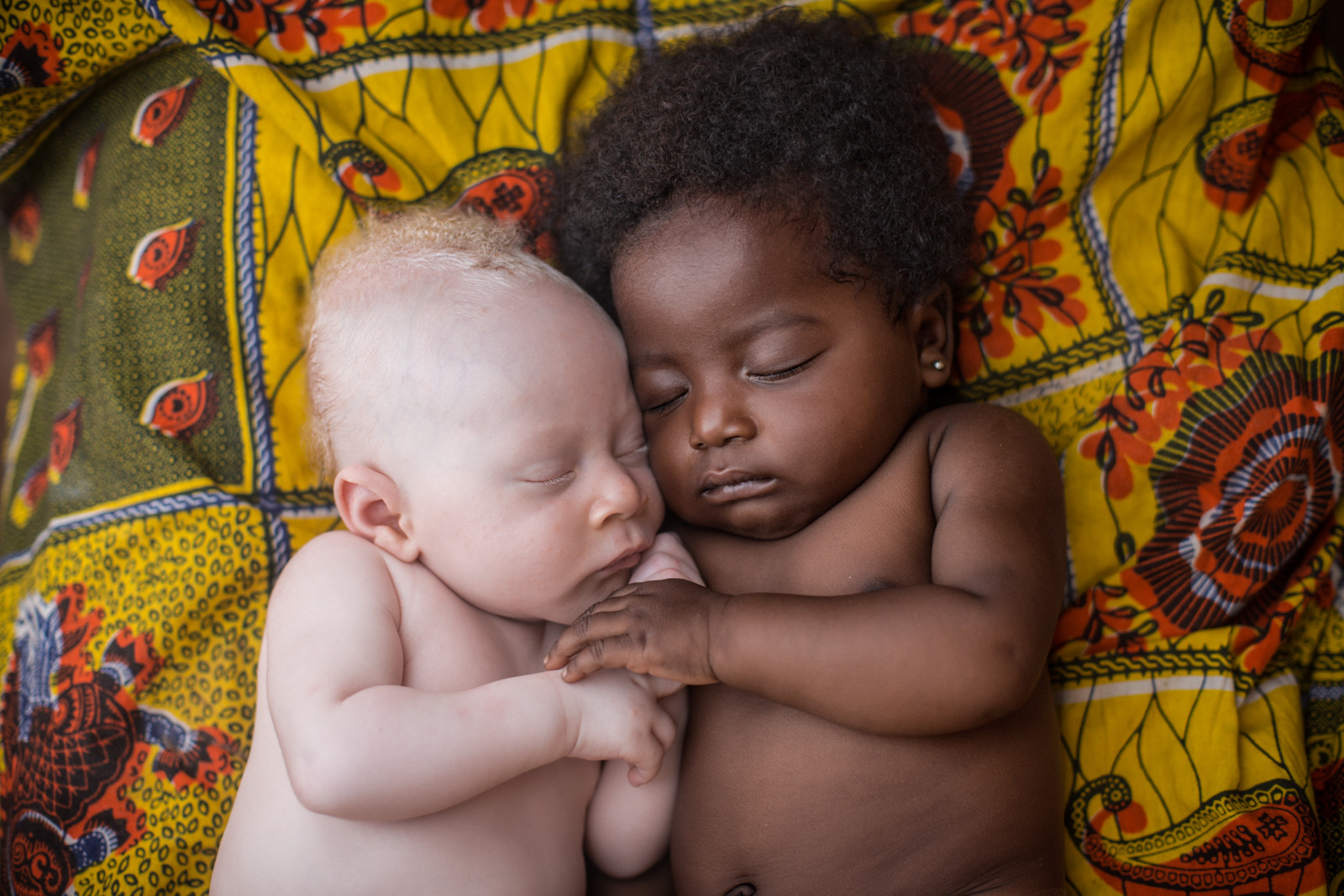 3 WEEKS-OLD NEWBORN WITH ALBINISM HAPPILY SLEEPING WITH HIS COUSIN IN KINSHASA, CONGO PHOTO PATRICIA WILLOCQ