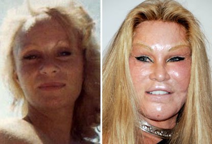 Jocelyn Wildenstein earned her nickname the cat woman after undergoing more than 4 million dollars worth of surgeries to look like a feline for her husband! Face lifts, lip augmentation, breast augmentation, eyebrow lifts are just a few of the procedures she has endured over the years.
