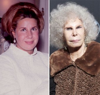 The Duchess of Alba is rumored to have undergone several surgeries over her 87 years, though has never disclosed the extent of her surgeries.