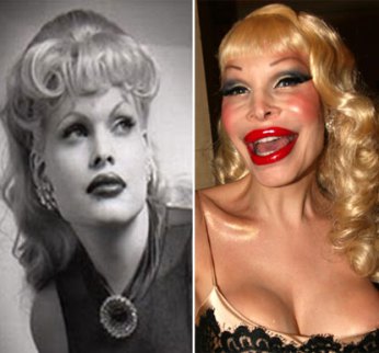 Amanda Lepore is a transsexual New York socialite who has gone way too far with plastic surgery! The model is said to have undergone multiple procedures in her lifetime, such as boob jobs, face lifts, nose jobs and lip injections.