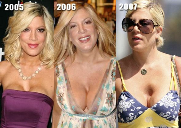 The pretty Tori Spelling who played Donna Martin in Beverly Hills 90210 opted for breast implants but instead of getting the hot and sexy look, she landed with breast that look like beach balls.