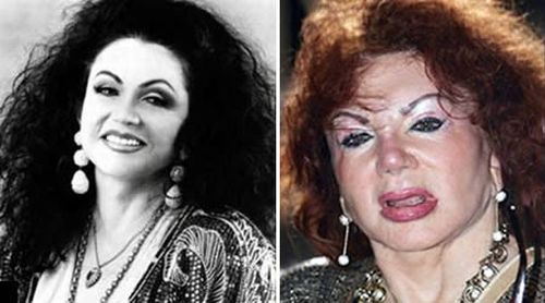 Jackie Stallone, mother of Silvester Stallone, is famous for her looks. Jackie Stallone had a little bit too much plastic surgery. She has tried everything: face lift, brow lift, cheek implants, nose job and, of course, lip jobs.