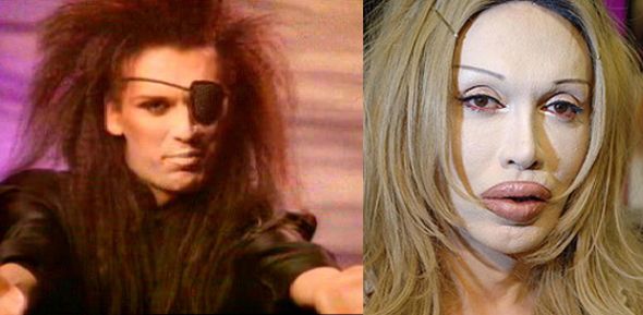 The former Dead or Alive front man, Pete Burns, had extensive lip injections, cheek implants and several nose jobs done to improve his physical beauty. He spent all his life saving on reconstructive surgery. One of his plastic surgery gone wrong and lip injections got infected and left him with a terrible scar.
