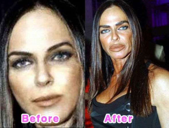 The very beautiful and famous Italian socialite Michaela Romanini, once known for her gorgeous looks is now famous for her collagen abuse. The 40 year old looks like a cartoon character of her former self. Her extreme addiction for lip injects and Botox has led her to have huge lips because her latest plastic surgery gone wrong.