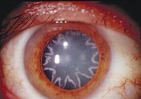 star-shaped cataracts formed after being shocked by 14,000 volts, after the cataracts were removed He regained some vision, doctors theorized that shock-waves caused the unusual pattern.