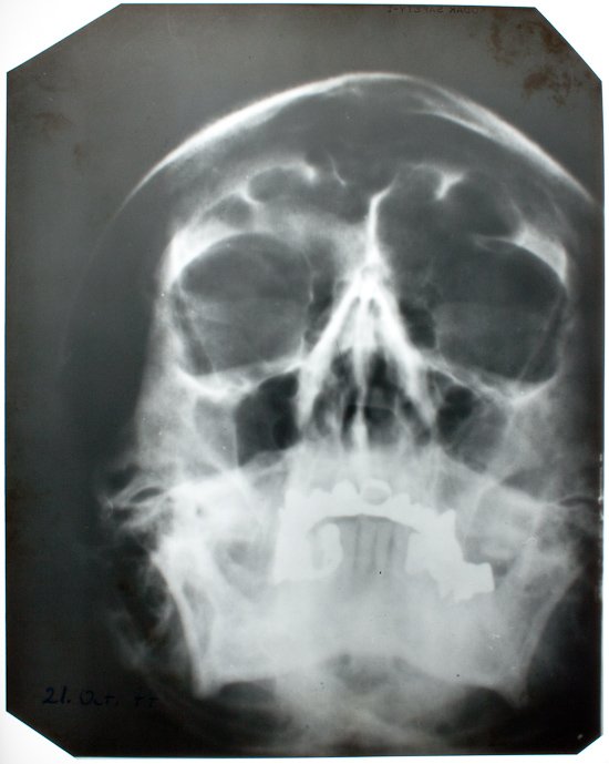 Adolf Hitlers Skull xrays and documents up released