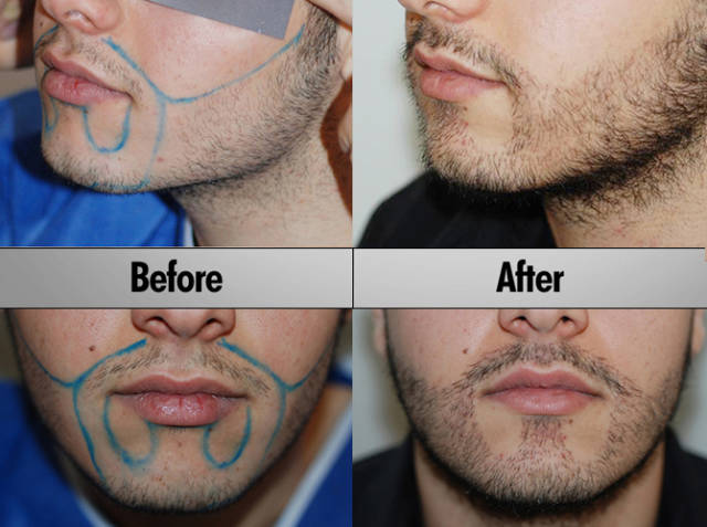 beard transplant on cheeks - Before After