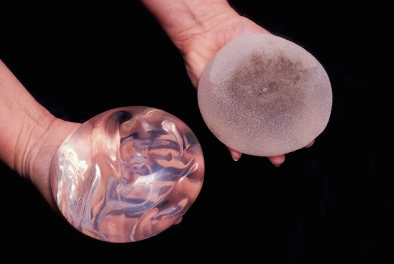 Approximately two million women in the United States have breast implants.