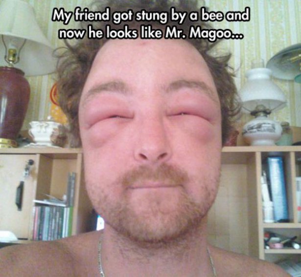 meme man with swollen eyes meme - My friend got stung by a bee and now he looks Mr. Magoo ...