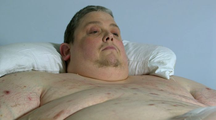 Photos Show Insides Of 980-Pound Man