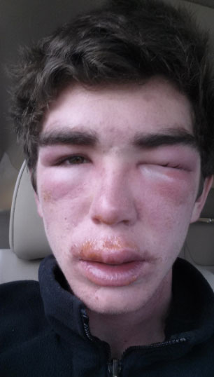 24 Cringeworthy Allergy Reactions