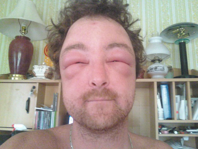 24 Cringeworthy Allergy Reactions
