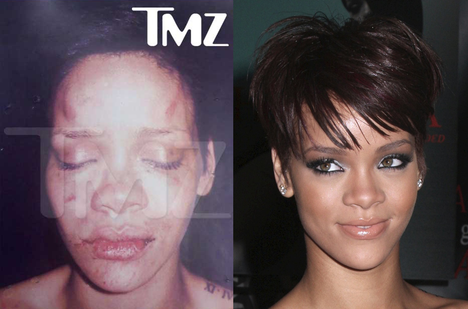 Rihanna's picture after she was attacked by Chris brown. Injured her lip eye forehead and nose,