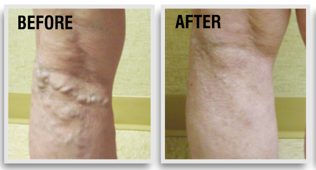 varicose veins treatment is one of the treatments which need to be handling with care otherwise whole life yours will  be ruin. Before taking any decision regarding your treatment you should know full details about your treatment as well as from where you feel comfortable for treatment.For know more about varicose veins treatment service visit www.
