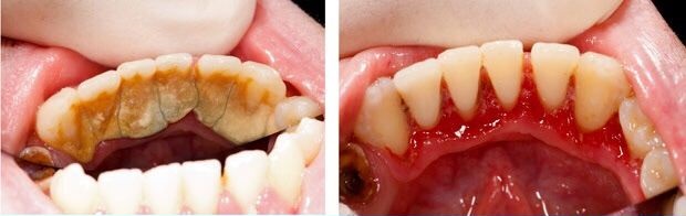 Before and after plaque cleaning. Take this as a lesson kids, brush your teeth.