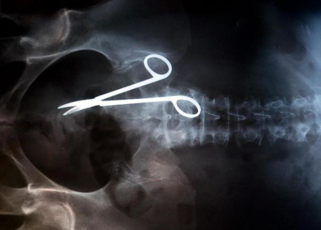 The Most Bizarre Items That Have Gotten Stuck in People's Bodies