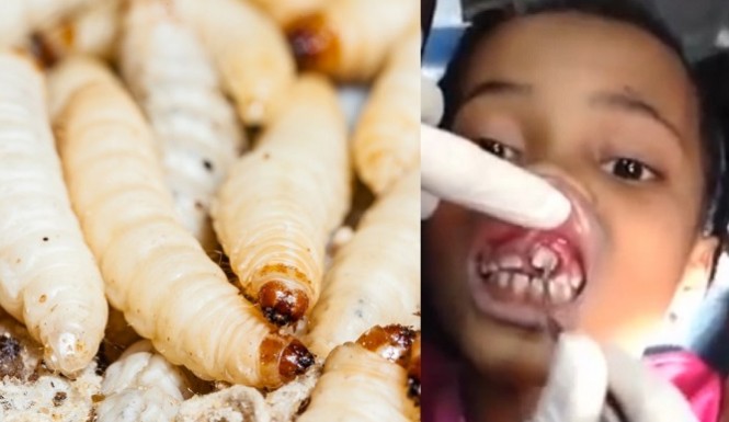 Little girl went to the dentist with a tooth ache and the dentist pulled out maggots.