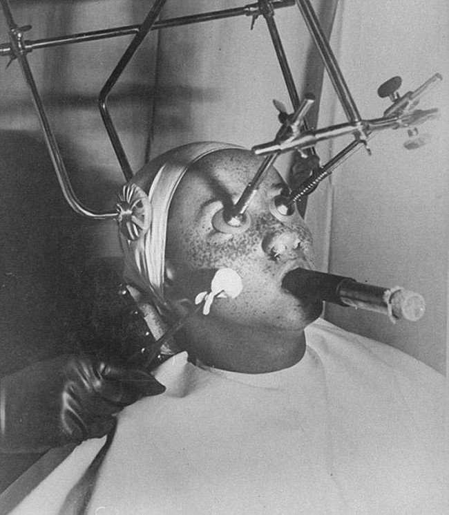 This is a procedure from the 1930s where doctors attempted to freeze off freckles using carbon dioxide. The patient's eyes were covered and their nose was plugged for their protection. They had to breath through a tube.