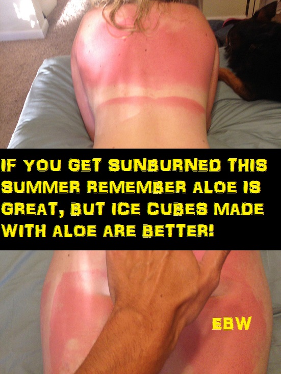 21 Insane Sunburns That Will Make You Fear the Sun