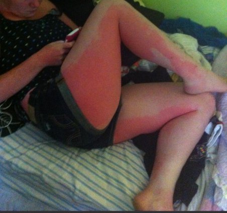 21 Insane Sunburns That Will Make You Fear the Sun