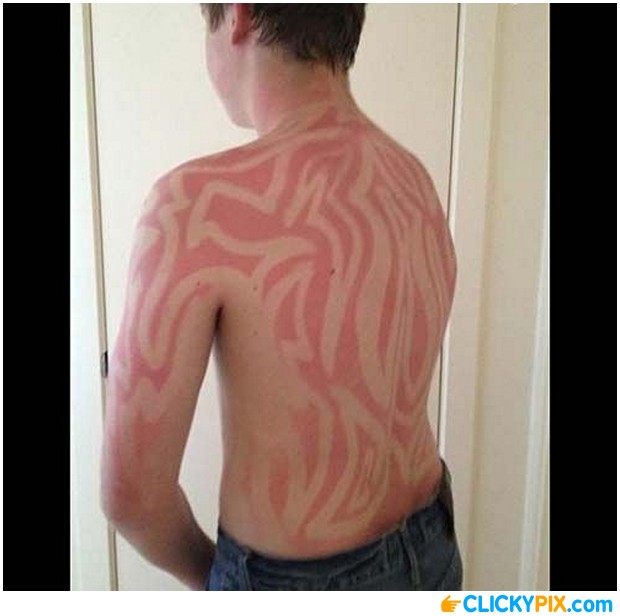 21 Insane Sunburns That Will Make You Fear the Sun