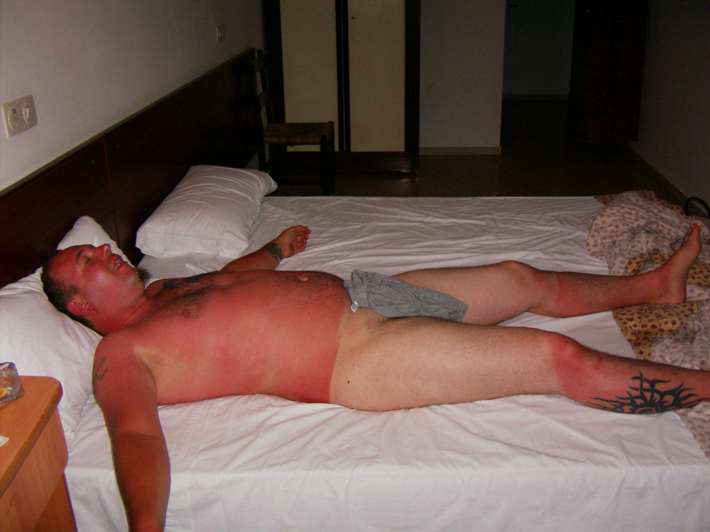 21 Insane Sunburns That Will Make You Fear the Sun