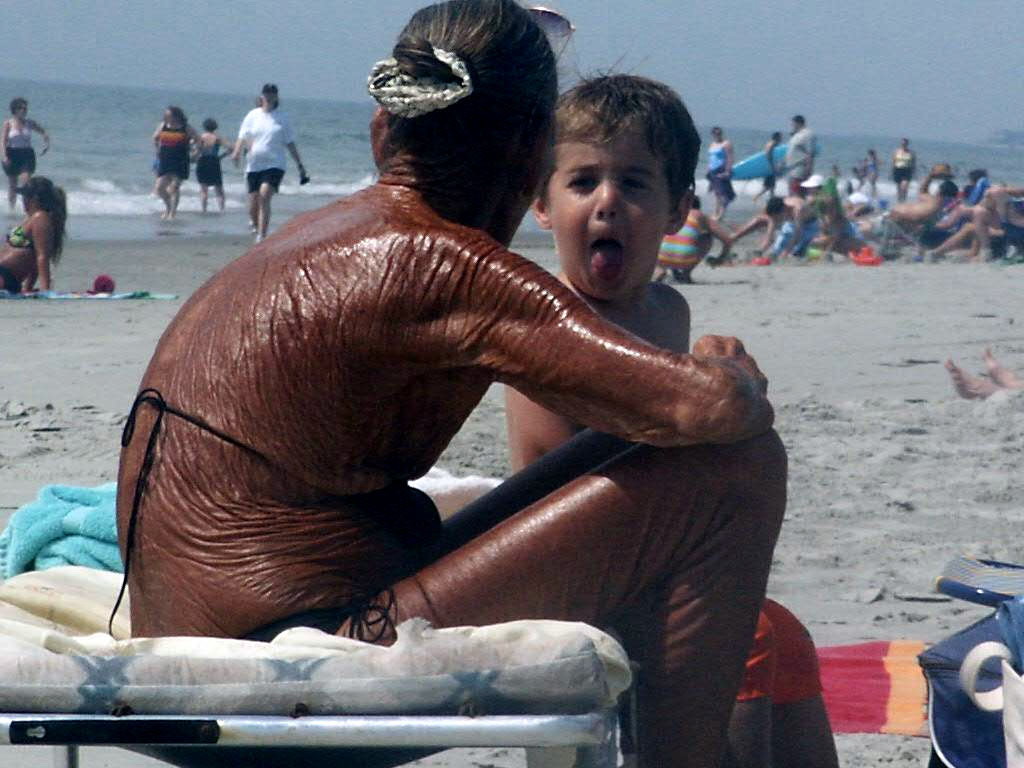 21 Insane Sunburns That Will Make You Fear the Sun