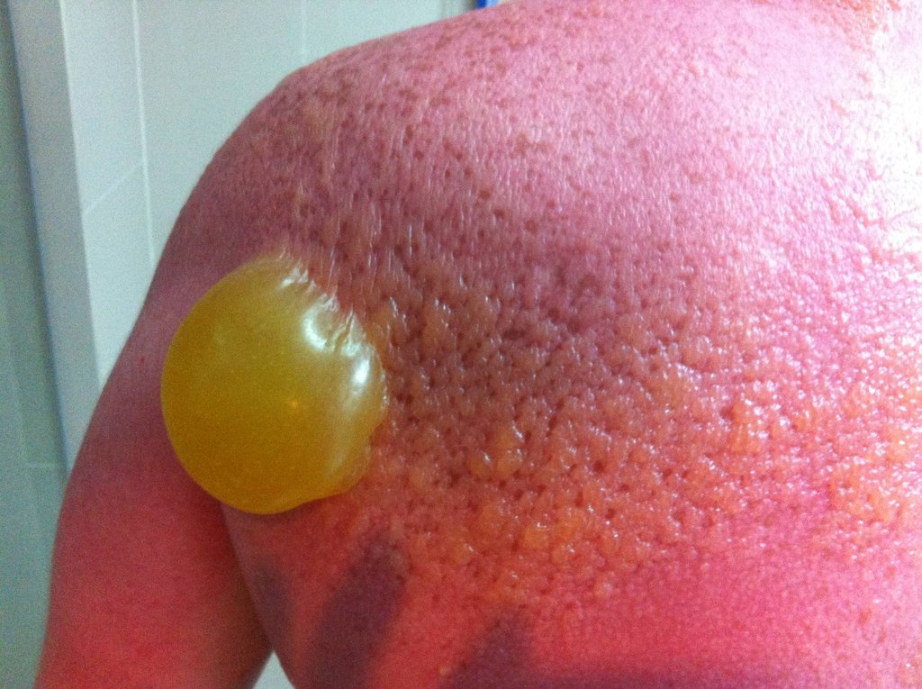 21 Insane Sunburns That Will Make You Fear the Sun