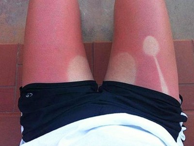 21 Insane Sunburns That Will Make You Fear the Sun