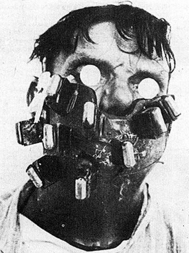 A radium mask, used in the 1920s to treat cancer of the face and neck.