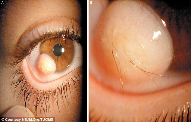 Hair growing on an eyeball from a limbal dermoid.