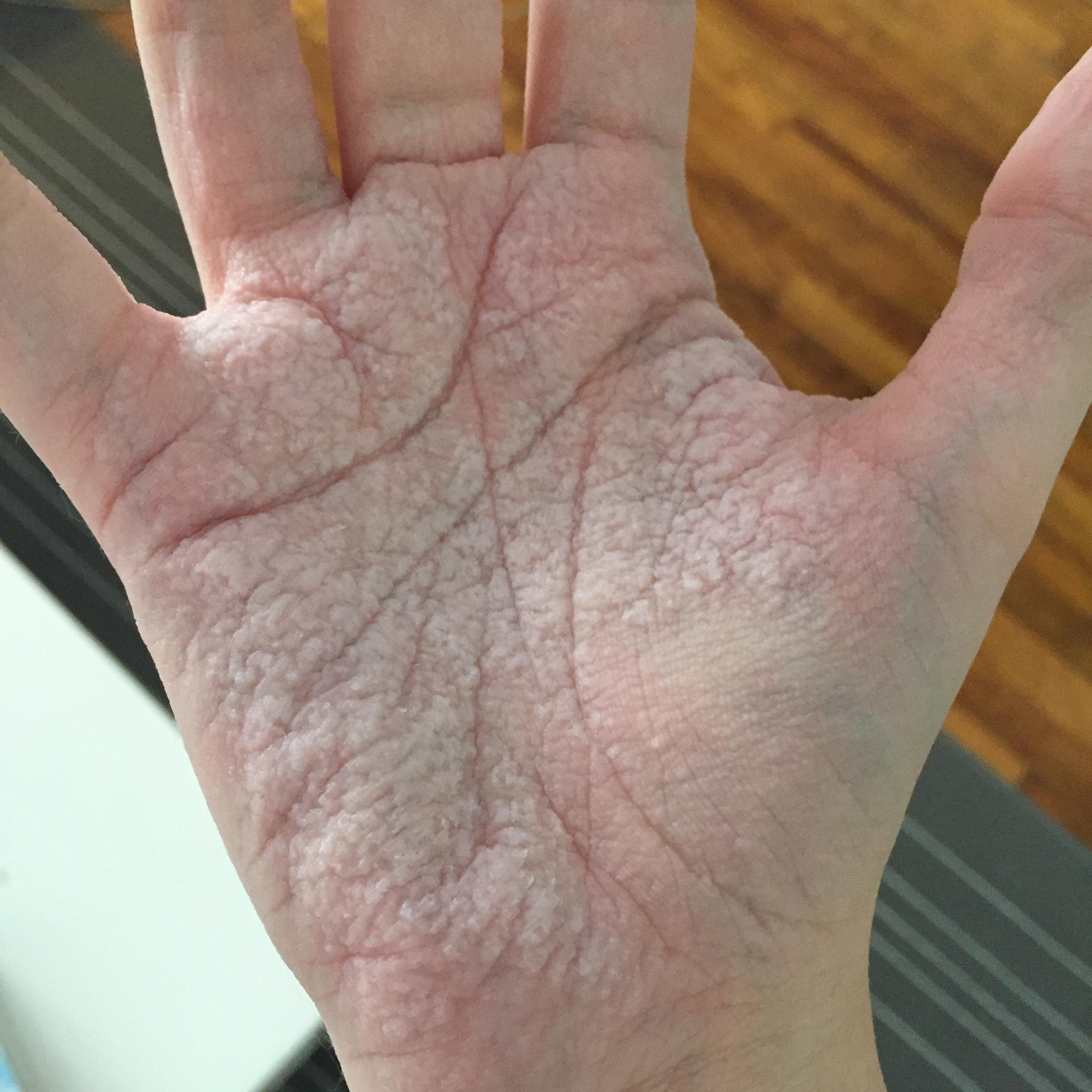 This man has a water sensitivity. This is his hand after a 15-minute shower.