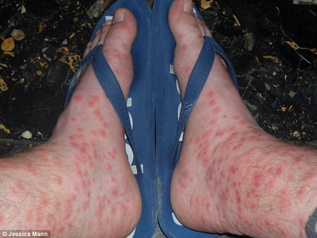 They were prescribed painkillers, steroids and creams for the large, irritable red blisters which burst.