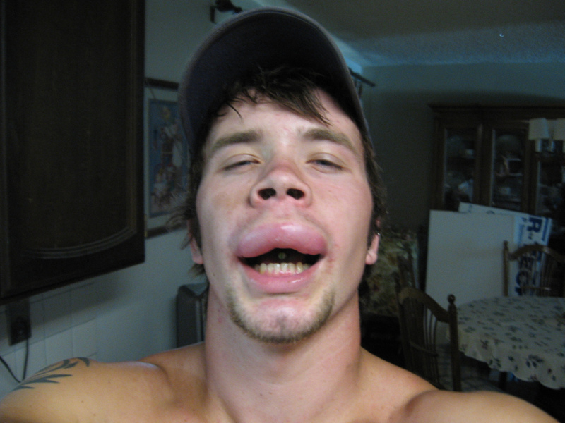 This man kissed a Bee and his stings allergic reaction is phat.