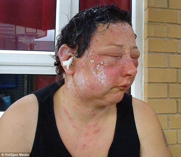 This mother suffers permanent sight damage after horrific allergic reaction to hair dye
