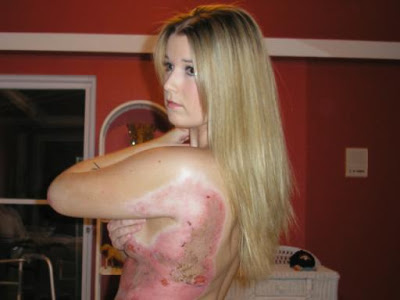 its extreme road rash and shes proud of it.