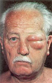 This man has severe allergic reaction to the Australian paralysis tick, Ixodes holocyclus. A larval tick was attached to the upper left eyelid for several hours only.