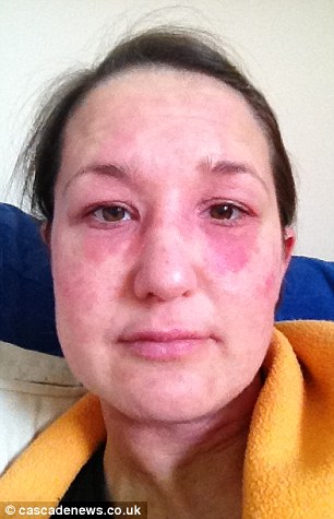 Sheryl Morris, 35, suffered a very severe reaction to the steroid cream she used for eczema that she needed to be hospitalized.
