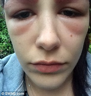 She was left with 'scabby' face and one eye swollen shut after having severe allergic reaction to beauty treatment to get thicker eyebrows