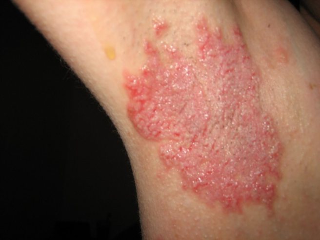 This guy got a nasty rash just using deaoderant.