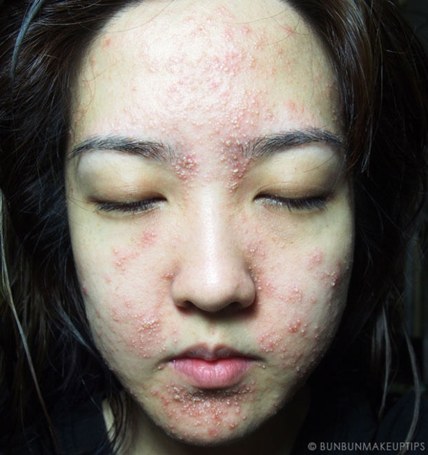 Her face only 3 days after the facial: