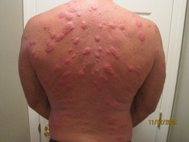 This person had a severe allergic reaction to bed bugs and the bites are extremely inflamed.