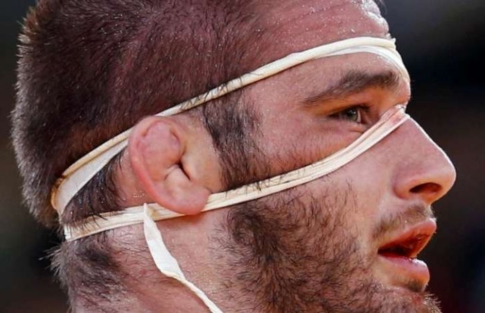 If You Have Cauliflower Ear: Got Cauliflower Ears? You are into sports... You were a boxer or wrestler, or footballer. You are a physically strong person.
