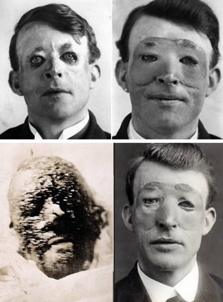 Walter Yeo, Known as the First Person to Have Plastic Surgery: Walter Yeo, a British sailor during World War I, is often cited as the first known person to have benefited from plastic surgery. Walter sustained terrible facial injuries, including the loss of his upper and lower eyelids, while manning the guns aboard the HMS Warspite in 1916 during the Battle of Jutland. The young sailor from Plymouth, Devon was given new eyelids with a "mask" of skin grafted across his face and eyes