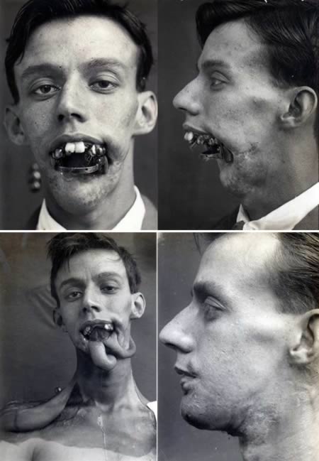 Willie Vicarage, the First Man to Receive Radical Reconstruction Via the "Tubed Pedicule" technique: Willie Vicarage, who was suffering from facial wounds that he sustained in the Battle of Jutland in 1916, was one of the first men to receive facial reconstruction using plastic surgery.Antibiotics had not yet been invented, meaning it was very hard to graft tissue from one part of the body to another because infection often developed. But while treating Vicarage, Dr. Gillies invented the tubed pedicle." This used a flap of skin from the chest or forehead and swung it into place over the face.The flap remained attached but was stitched into a tube. This kept the original blood supply intact and dramatically reduced the infection rate.